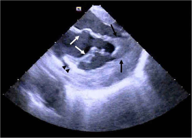 EP study catheter in the heart