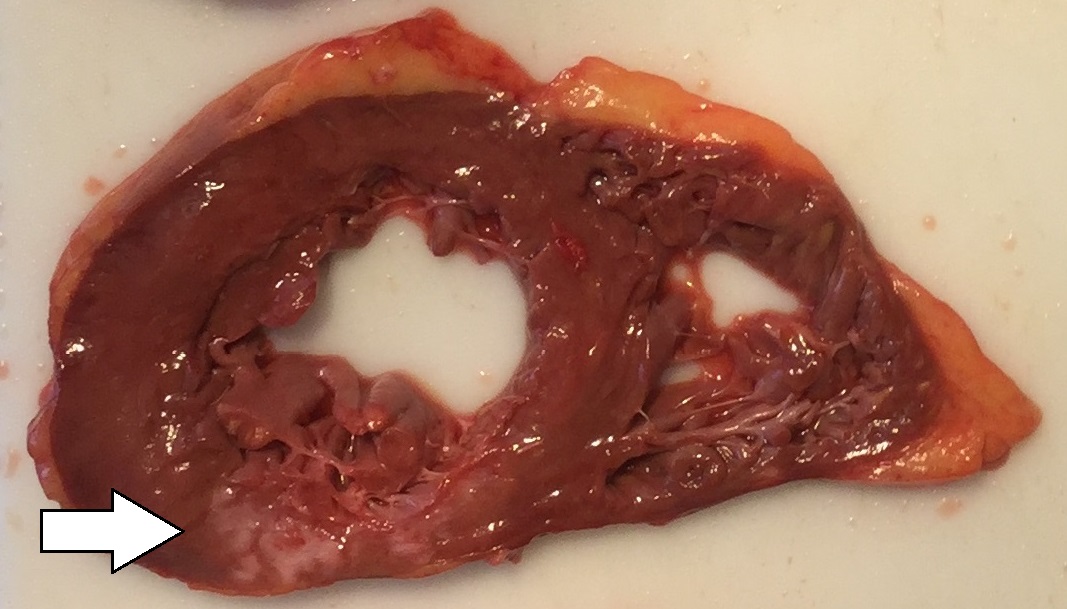 Gross pathology of myocardial infarction scar