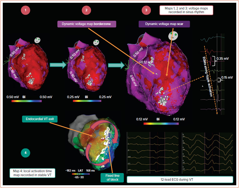 Electroanatomic voltage map of left ventricle